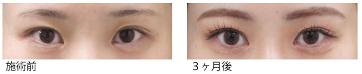 目頭切開による目の整形例(ソノクリニックHPより引用)の画像