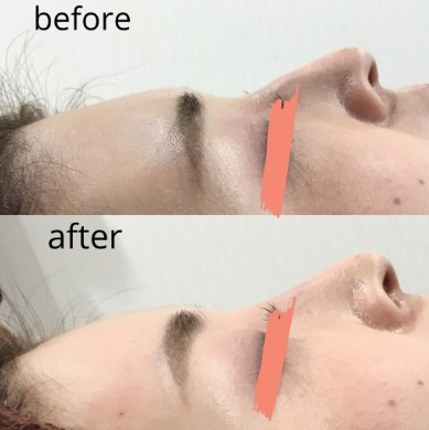 ヒアルロン酸注射による鼻の整形例（エルムクリニックHPより引用）の画像