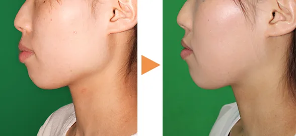 骨削りによる顎の整形例(自由が丘クリニックHPより引用)