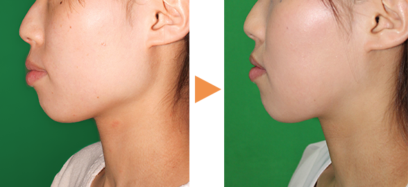 骨削りによる顎の整形例（自由が丘クリニックHPより引用）の画像