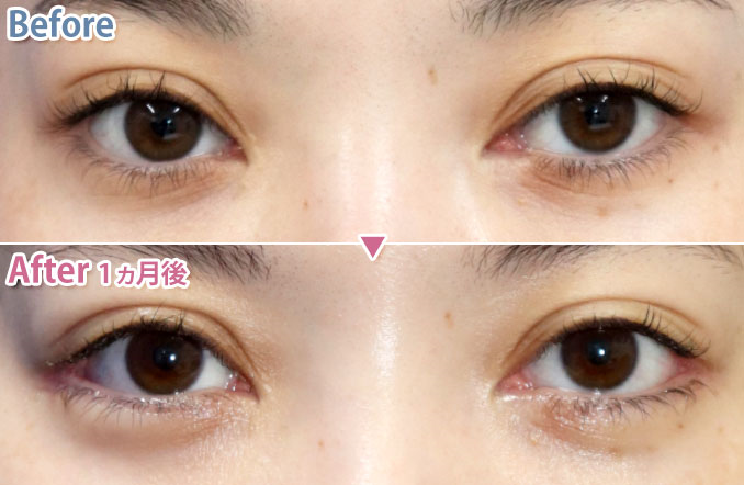 目尻切開による目の整形例（あつぎ美容クリニックHPより引用）の画像