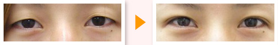 二重埋没法による目の整形例（かわた美容クリニックHPより引用）の画像
