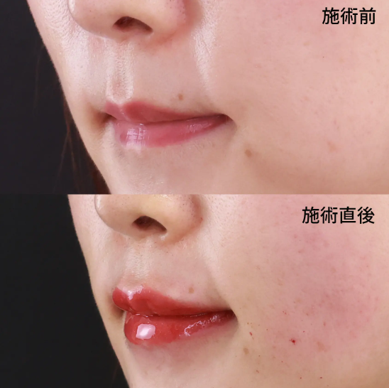 ヒアルロン酸注射による唇の整形例（TAクリニックグループHPより引用）の画像