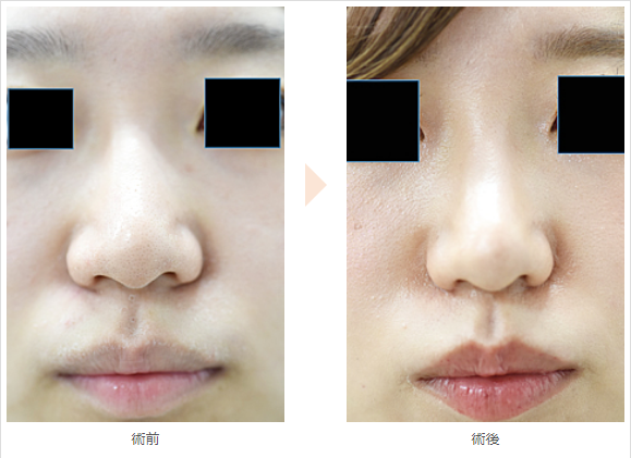 小鼻縮小術による鼻の整形例（みずほクリニックHPより引用）の画像