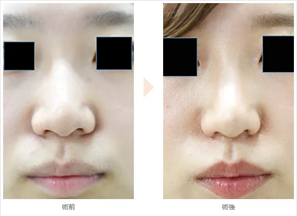 小鼻縮小術による鼻の整形例（みずほクリニックHPより引用）