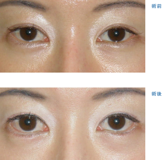 下眼瞼開大術による目の整形例（銀座みゆき通り美容外科大阪院HPより引用）の画像