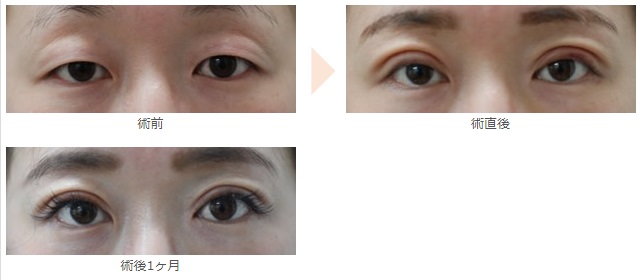 二重切開法による目の整形例（みずほクリニックHPより引用）の画像