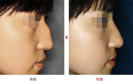 わし鼻修正による鼻の整形例（真崎医院HPより引用）の画像