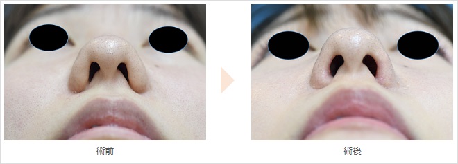 鼻翼厚み除去による鼻の整形例（みずほクリニックHPより引用）の画像