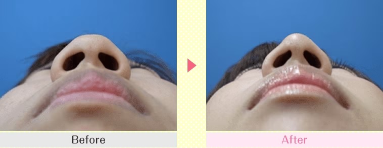 鼻尖形成術による鼻の整形例（湘南美容クリニックHPより引用）の画像