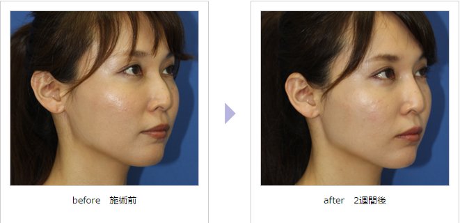ボトックス注射による鼻の整形例（オザキクリニック公式SNSより引用）の画像