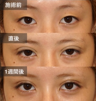 二重埋没法による目の整形例（ツツイ美容外科HPより引用）の画像