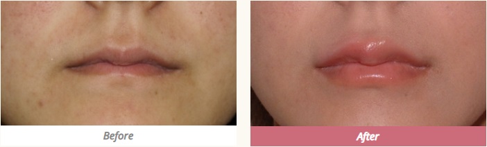 ヒアルロン酸注射による唇の整形例（ツツイ美容外科HPより引用）の画像