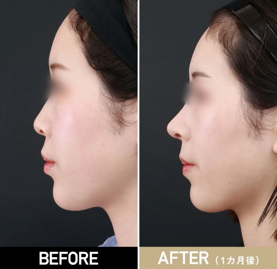 鼻プロテーゼによる鼻の整形例（TAクリニックグループHPより引用）の画像