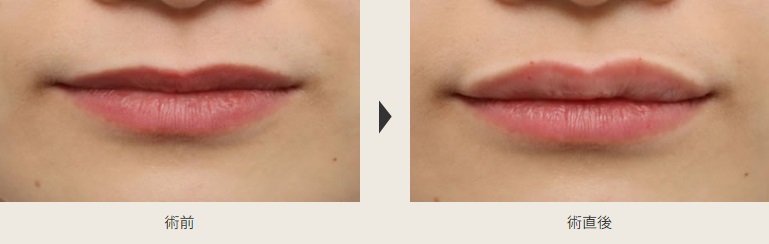 ヒアルロン酸注射による唇の整形例（よだ形成外科クリニックHPより引用）の画像