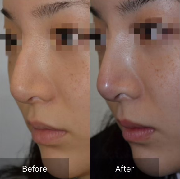 鼻プロテーゼによる鼻の整形例（アテナクリニックHPより引用）の画像