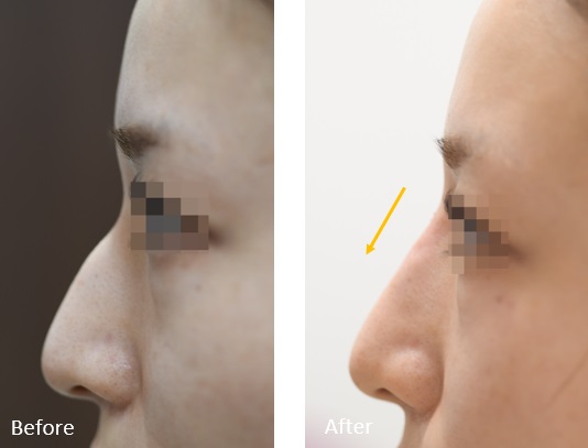 ヒアルロン酸注射による鼻の整形例（みずほクリニックHPより引用）の画像