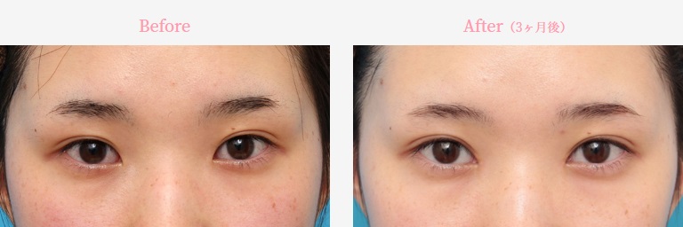 目頭切開による目の整形例（高須クリニックHPより引用）の画像