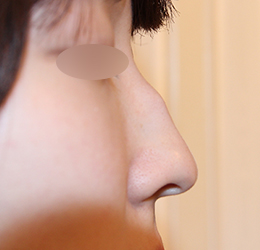 鼻の中央が出っ張ったわし鼻の画像（ヒルズ美容クリニックHPから引用）の画像