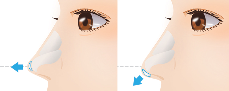 鼻先を長くする鼻尖形成の例（ヴィーナスビューティークリニックHPより引用）の画像