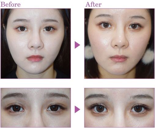 下眼瞼開大術による目の整形例（ノエル銀座クリニックHPより引用）の画像