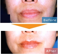 口唇縮小術による唇の整形例（コムロクリニックHPより引用）の画像