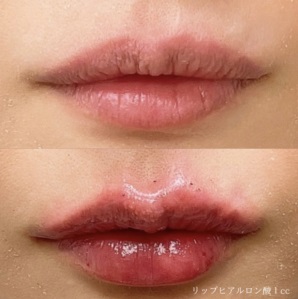 ヒアルロン酸注射による唇の整形例（あゆ皮フ科クリニックHPより引用）の画像