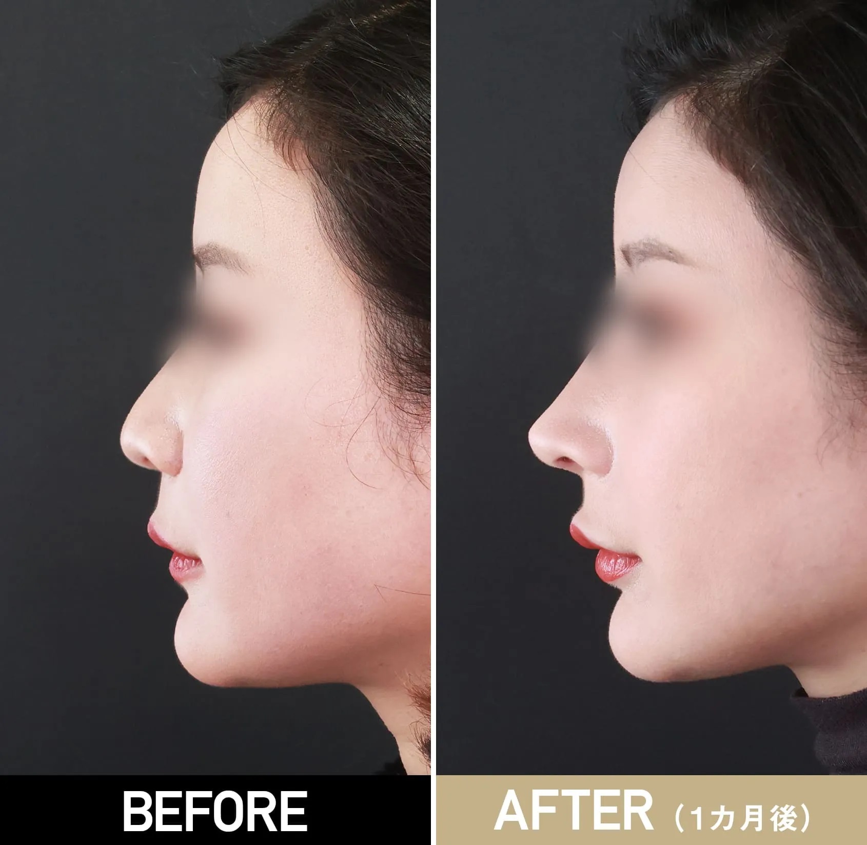 鼻プロテーゼによる鼻の整形例（TAクリニックグループHPより引用）の画像