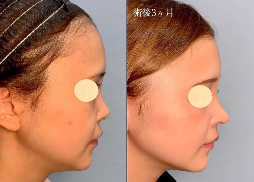 鼻尖形成術による鼻の整形例（eクリニックHPより引用）の画像