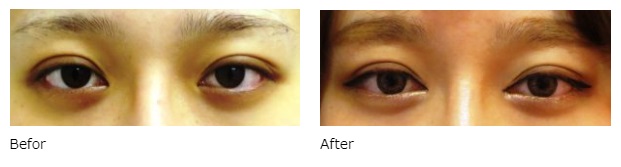 目頭切開による目の整形例（広島プルミエクリニックHPより引用）の画像