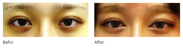 目頭切開による目の整形例（広島プルミエクリニックHPより引用）の画像