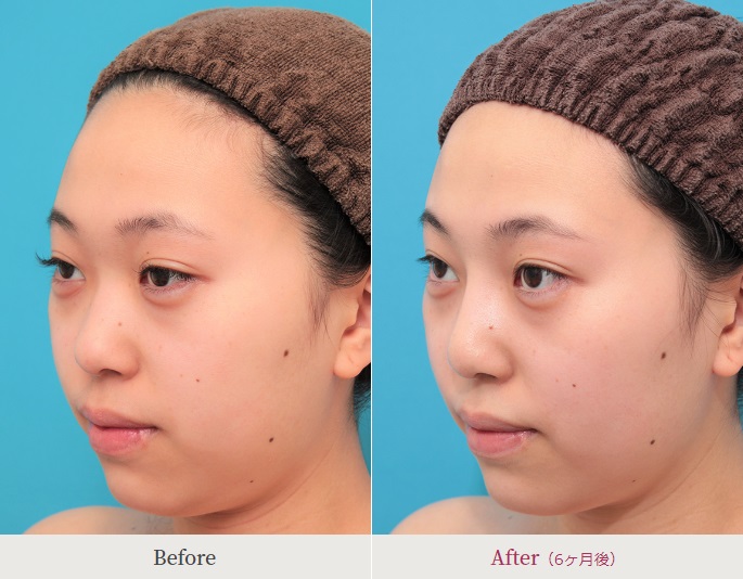 鼻プロテーゼによる鼻の整形例（高須クリニックHPより引用）の画像