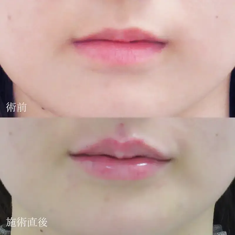 ヒアルロン酸注射による唇の整形例（水の森美容外科HPより引用）の画像