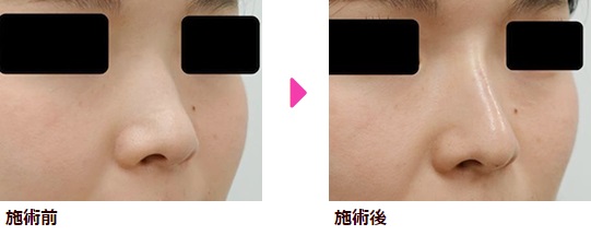 ヒアルロン酸注射による鼻の整形例（品川スキンクリニック美容皮フ科HPより引用）の画像
