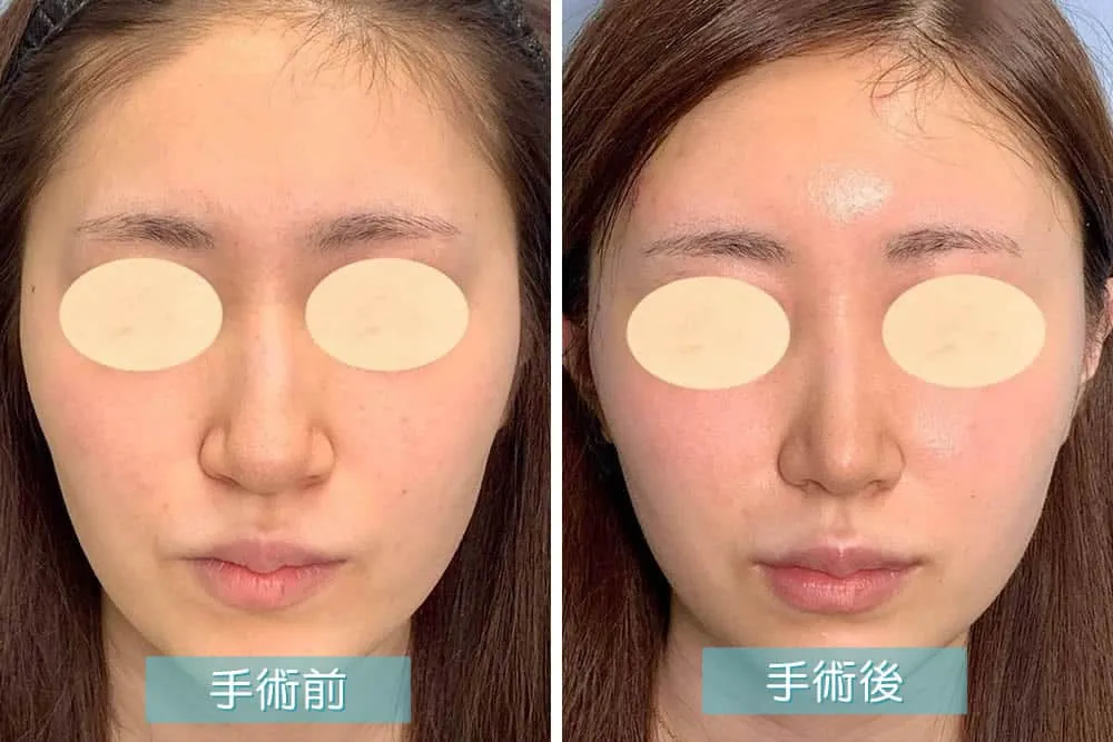 小鼻縮小術による鼻の整形例（eクリニック大阪院HPより引用）