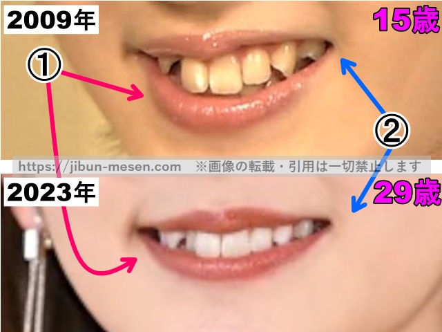 鈴木愛理の唇の整形検証2009年〜2023年（拡大）の画像
