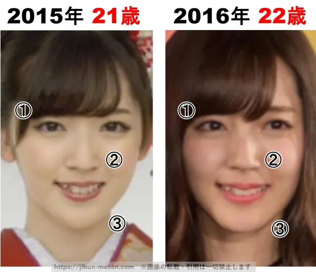 鈴木愛理の整形検証2015年〜2016年