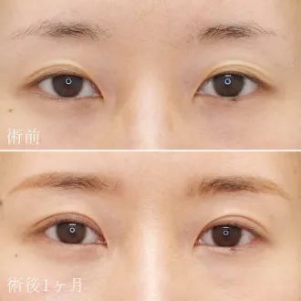 二重切開法による目の整形例(水の森美容クリニックHPより引用)
