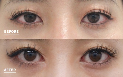 目頭切開による目の整形例（水の森美容クリニックHPより引用）の画像