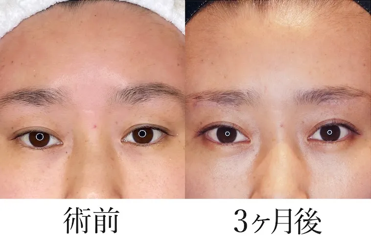 二重埋没法による目の整形例(ヴィーナスビューティークリニックHPより引用)