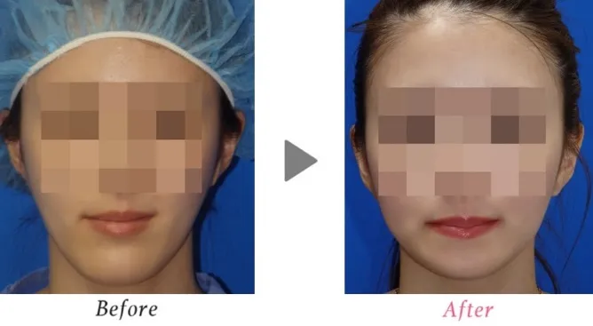 顎削りによる顎の整形例(小木曽クリニックHPより引用)