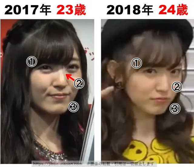 鈴木愛理の整形検証2017年〜2018年