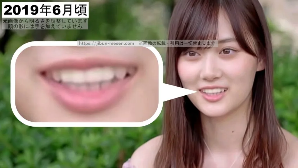 歯並びが改善された山下美月