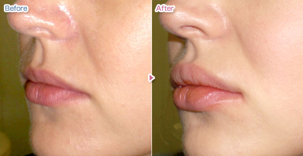 ヒアルロン酸注射による唇の整形例（あつぎ美容クリニックHPより引用）の画像