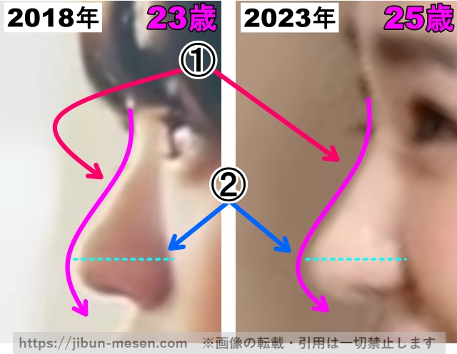 奈緒の鼻の整形検証2018年〜2023年（横顔・拡大）の画像