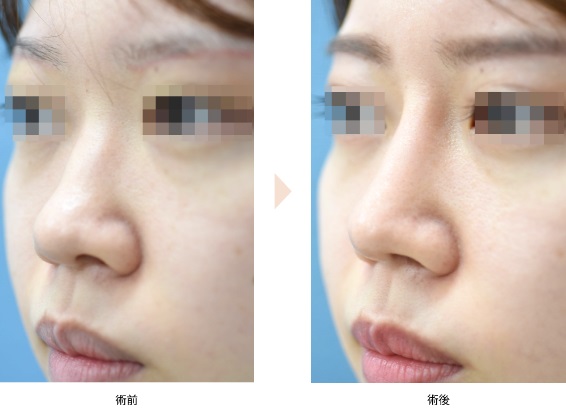 鼻プロテーゼによる鼻の整形例（みずほクリニックHPより引用）の画像