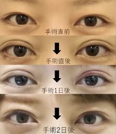 二重埋没法のダウンタイムの様子(湘南美容クリニックHPより引用)の画像