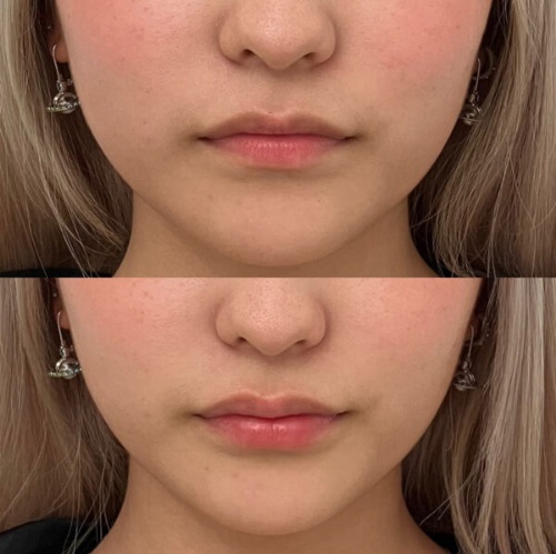 ヒアルロン酸注射による唇の整形例（キリクリニックHPより引用）の画像