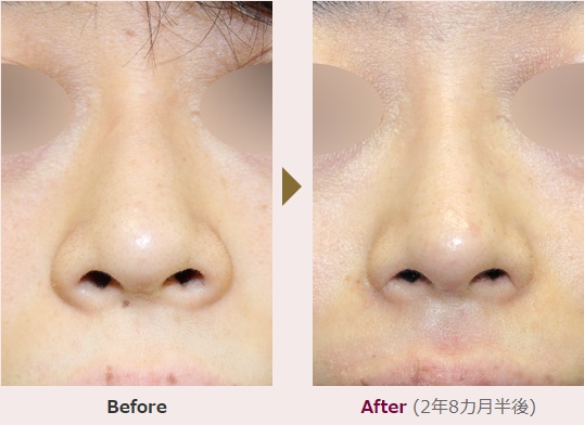小鼻縮小術による鼻の整形例（ヒルズ美容クリニックHPより引用）の画像