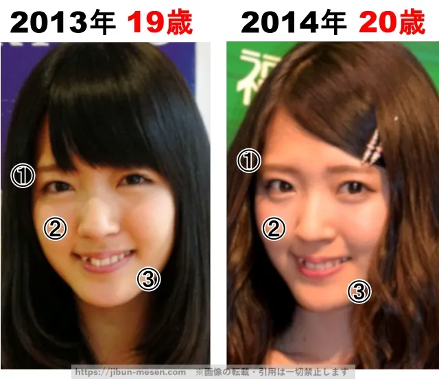 鈴木愛理の整形検証2013年〜2014年